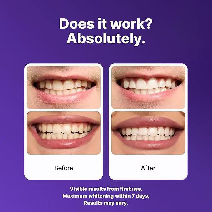 Juxek™ New 2nd Generation Purple Teeth Whitening Strips（2）